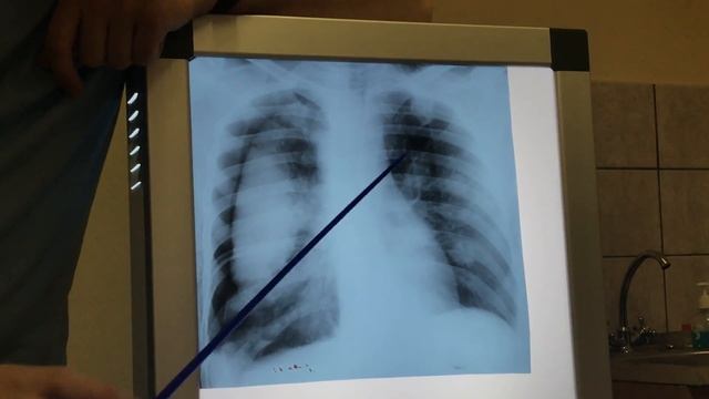 Рак лёгких рентген Lung Cancer