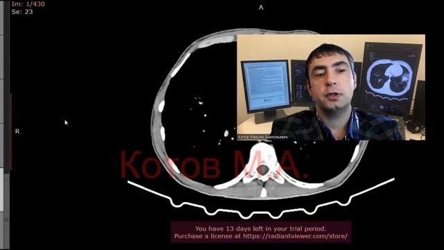 Удвоение почки. Ролик №57 смотреть онлайн