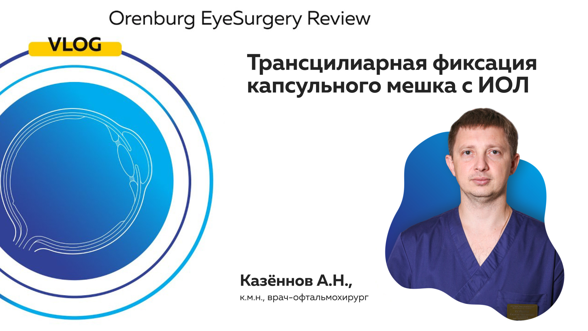 Трансцилиарная фиксация капсульного мешка с ИОЛ