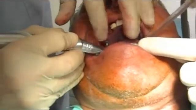 HOW TO MAKE IMMEDIATE LOADFING WITH NOBEL IMPLANT смотреть онлайн