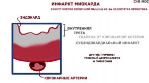 Инфаркт миокарда - обзорно - причины, патофизиология, симптомы, ЭКГ