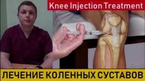 Внутрисуставные инъекции в коленный сустав