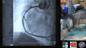 20170210 Стентирование коронарной артерии саморассасывающимся стентом Absorb