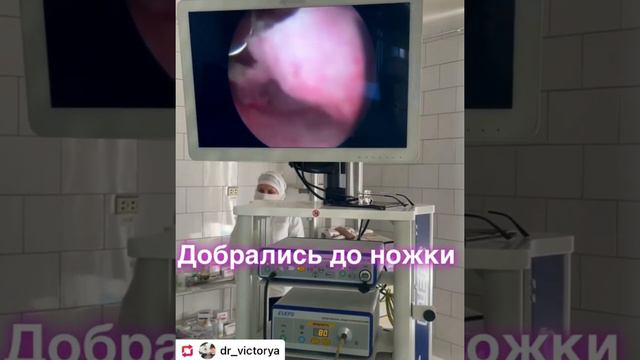 HRS polypectomy. Полипэктомия. смотреть онлайн