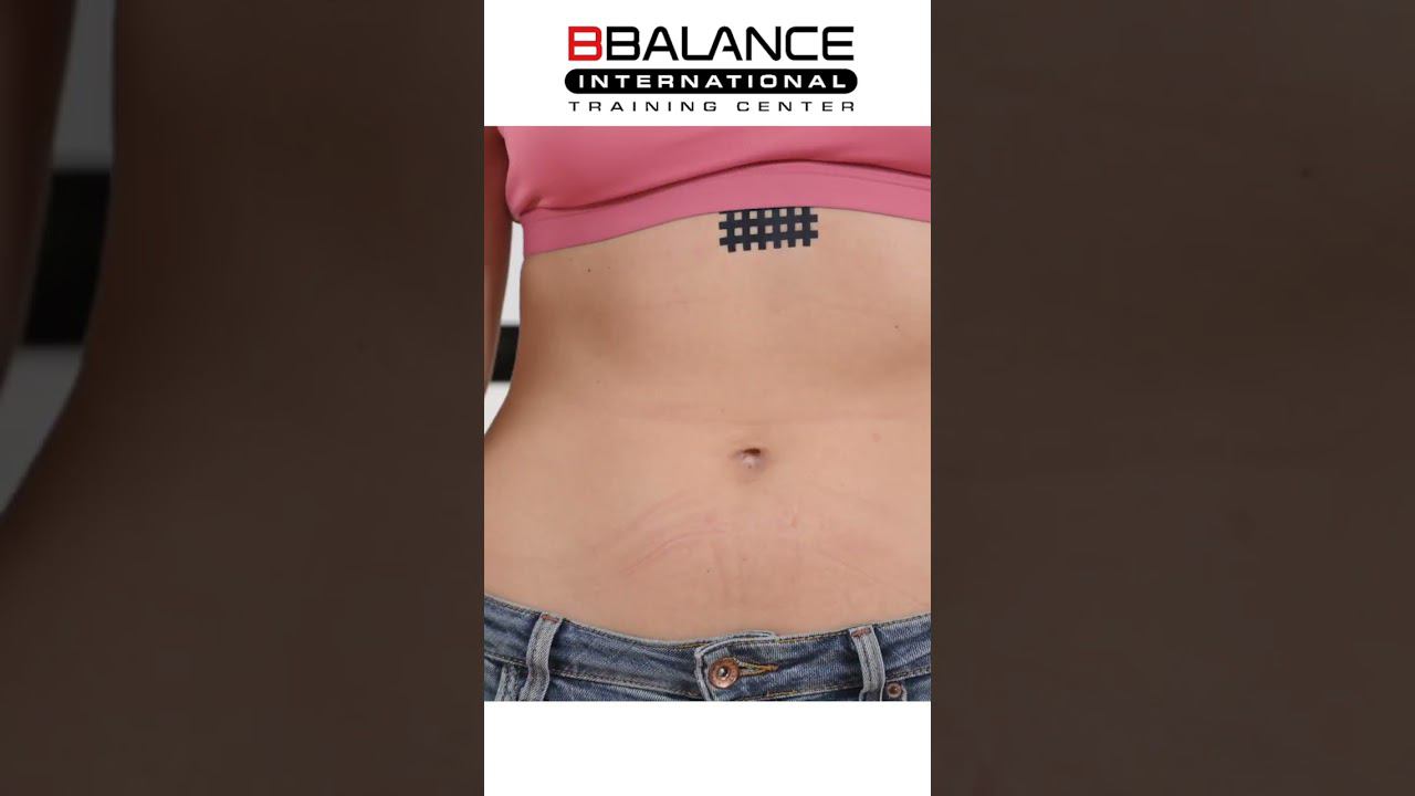 Кросстейпирование для улучшения работы диафрагмы. смотреть онлайн