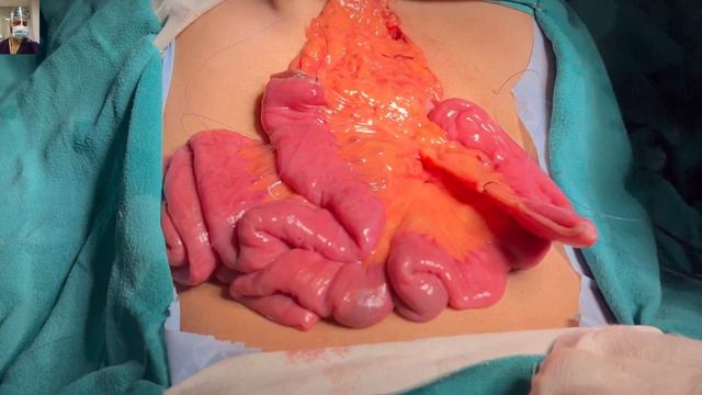 Roux-en-Y Gastrojejunostomy for Post-Corrosive GOO (Part 1): Comprehensive Guide. #StomachSurgery смотреть онлайн