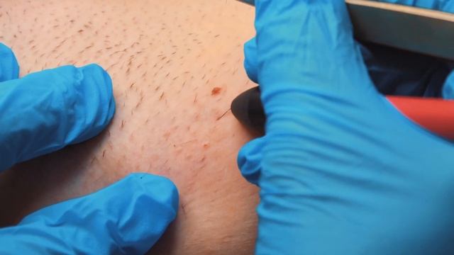 Процедура Электроэпиляция. Студия LYSENKO смотреть онлайн