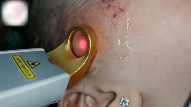 KTP/Nd:YAG ЛАЗЕР (EXCEL V CUTERA) смотреть онлайн