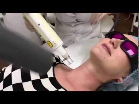 ФРАКЦИОННЫЙ ТЕРМОЛИЗ на FOTONA в Клинике Градиент смотреть онлайн