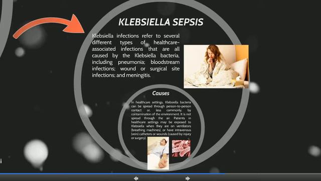 Hypopyon and Klebsiella sepsis смотреть онлайн