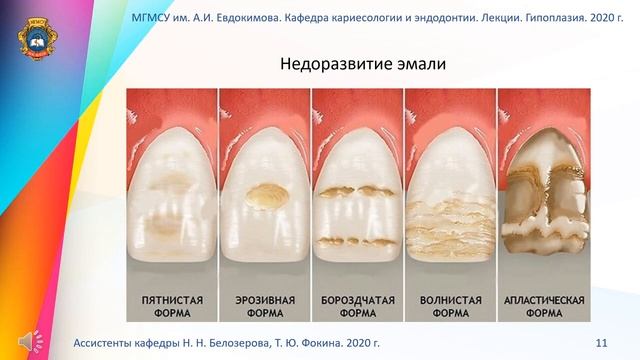 3 курс. Тема №2. Гипоплазия эмали. Виды. Патологическая анатомия. Методы диагностики. смотреть онлайн