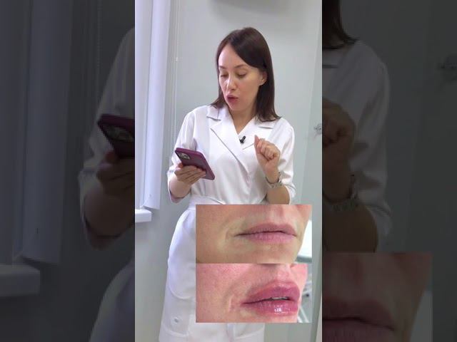 Контурная пластика губ (до/после) смотреть онлайн