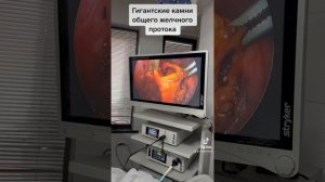Лапароскопическое удаление камней из желчного протока. #холецистит  #камнивжелчном #эндоскопия