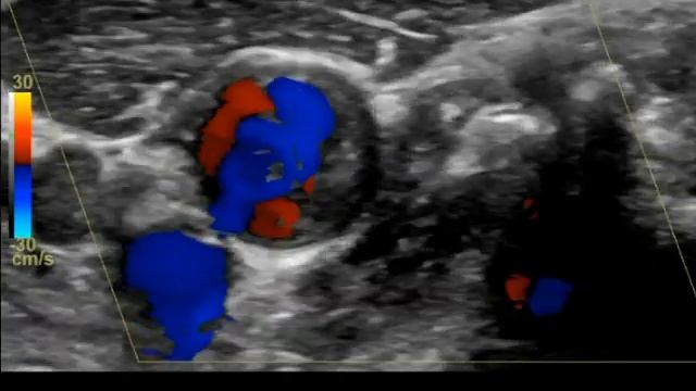 пристеночный тромб ВСА