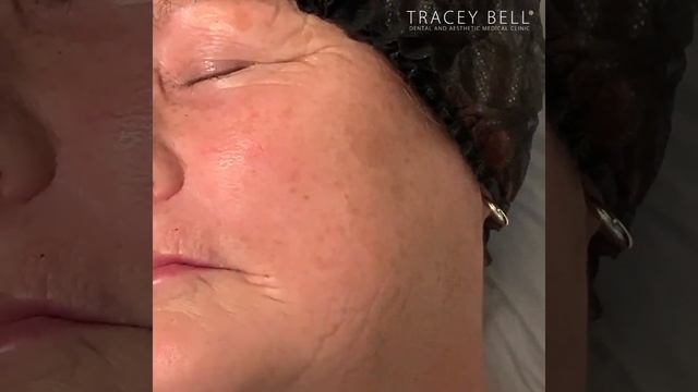 Belotero Lips - Treating lines around the mouth - Timelapse Video смотреть онлайн