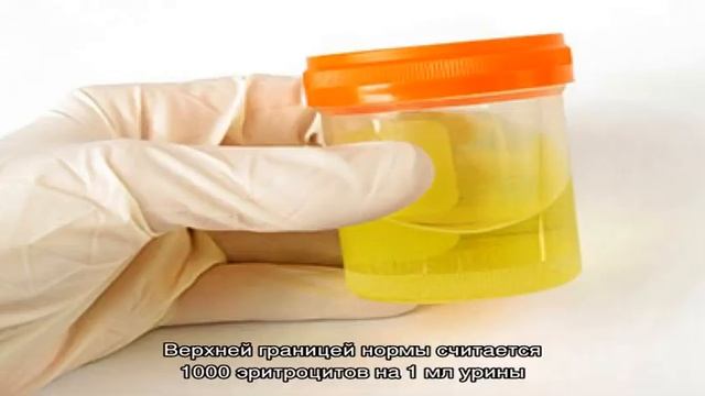 Эритроциты в моче