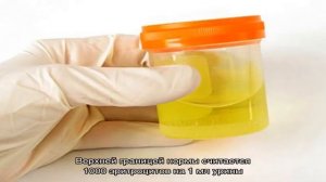 Эритроциты в моче