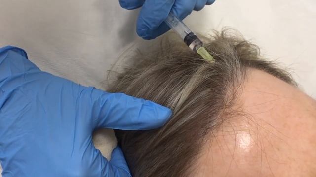 Мезотерапия волосистой части головы (мезотерапия волос) в МЦ Корона