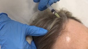 Мезотерапия волосистой части головы (мезотерапия волос) в МЦ Корона