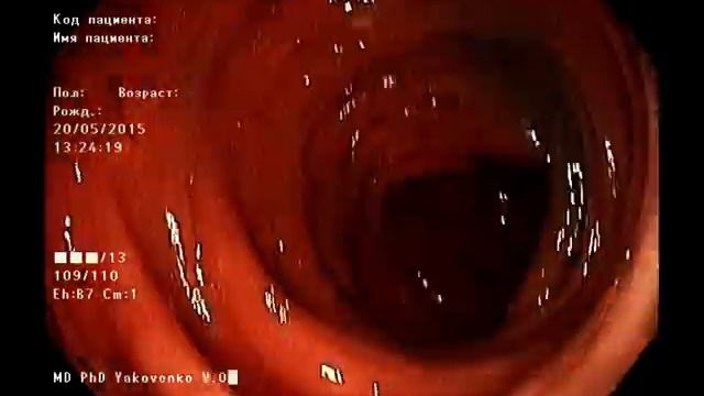 Endoscopic colon tattooing after 2,5 years. Эндоскопическая татуировка толстой кишки смотреть онлайн