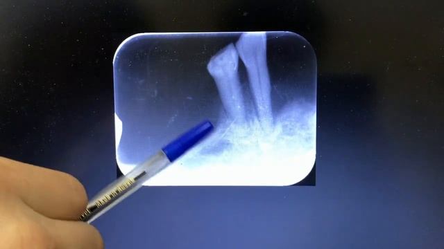 Рентген зубов - анализ состояния зубов перед изготовлением акрилового съемного протеза смотреть онлайн