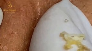 Relax squeezing out blackheads#4 Черные точки