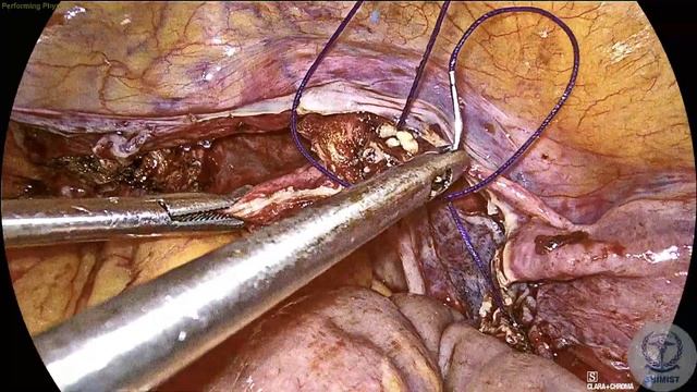 TLH with B/L SALPINGO-OOPHORECTOMY WITH SENTINEL LYMPH NODE BIOPSY ICG & LAP BURCH COLPOSUSPENSION смотреть онлайн