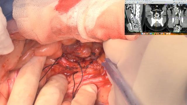 Live stream - sublumbar lymph node removal in a dog with anal sac adenocarcinoma смотреть онлайн