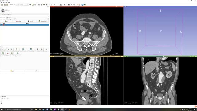 3D Slicer Tutorial #2: Manual segmentation. Thresholding. смотреть онлайн
