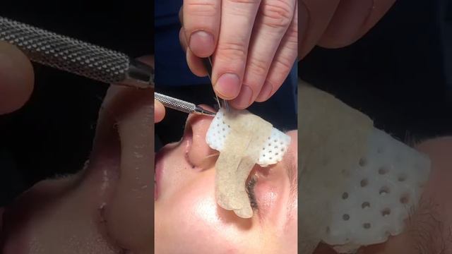 Ринопластика | Рождение идеального носа