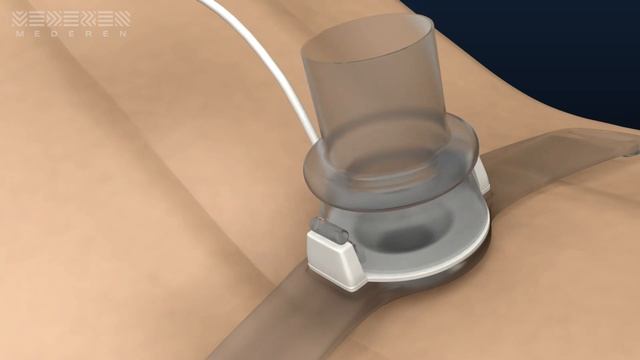 Трубка трахеостомическая со съемными канюлями R-Trach MEDEREN смотреть онлайн