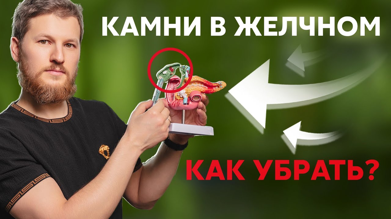 Камни в желчном пузыре - как убрать? смотреть онлайн