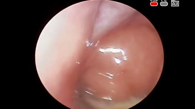 Почему не дышит нос у ребенка #Видео 2 КЛИНИКА ОБРАЗЦОВА #Аденоиды 3 степени Гнойный #аденоидит смотреть онлайн