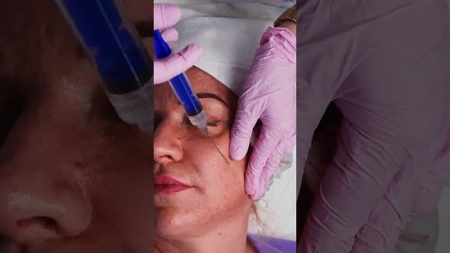 Каркасный биолифтинг жидкими бионитями Derli FIBROLIFT