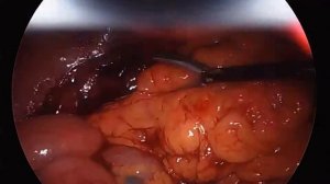 Рак прямой кишки