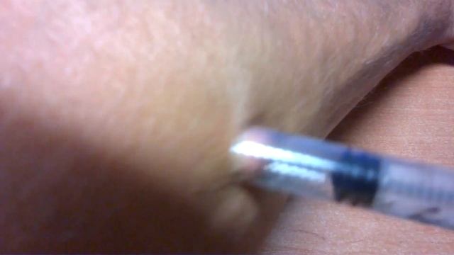 Можно ли вытащить клеща шприцом Эксперимент How to Remove a tick Поддубные смотреть онлайн