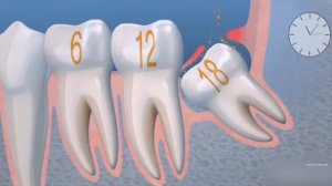 Что будет, если не удалять зуб мудрости?