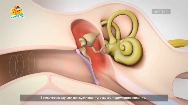 Что такое кондуктивная тугоухость? (субтитры) смотреть онлайн