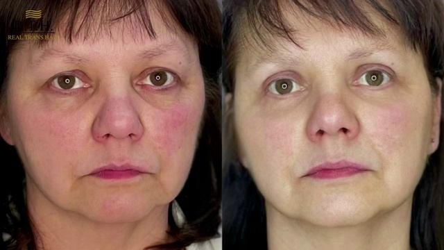 Блефаропластика: ДО и ПОСЛЕ