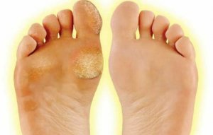 10 МИНУТ и НАТОПТЫШЕЙ и МОЗОЛЕЙ как не бывало