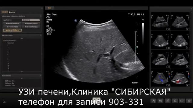 УЗИ с эластографией смотреть онлайн