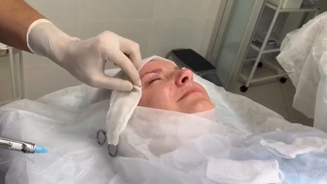 Липофилинг носослезки и верхних век смотреть онлайн
