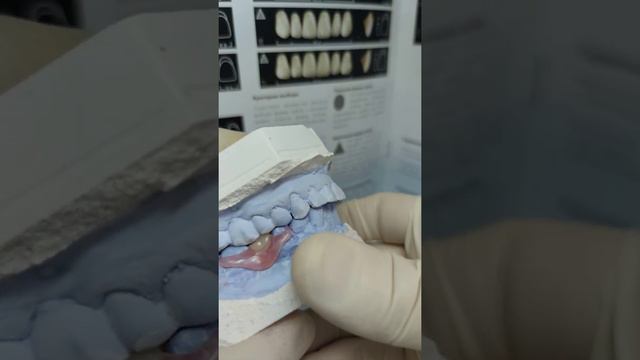 Протез бабочка 🦋 смотреть онлайн