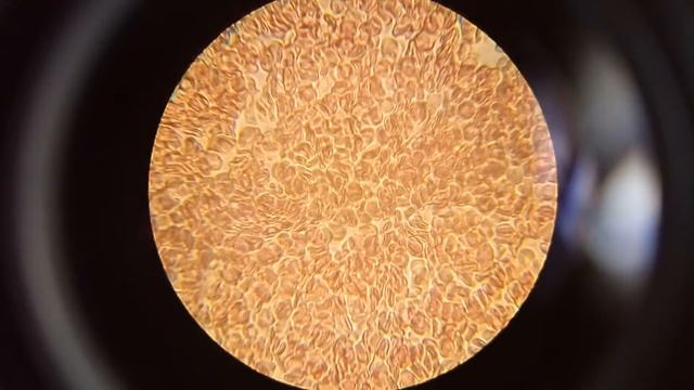 Что сделала лапша с кровью? Видели такое?