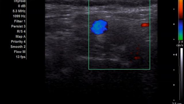 Тромботическая окклюзия ВСА смотреть онлайн