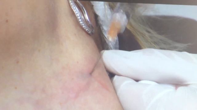 Новая техника омоложения шеи с препаратом PROFHILO - estet-portal.com смотреть онлайн