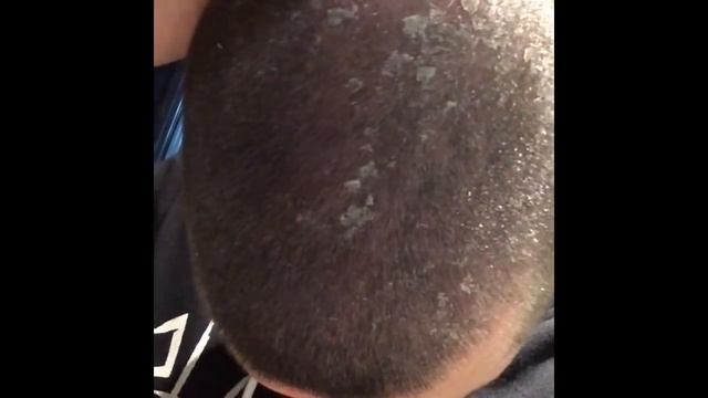 Best Dandruff Compilation