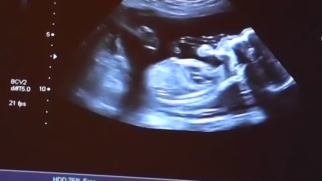 узи мальчик 19-20 нед