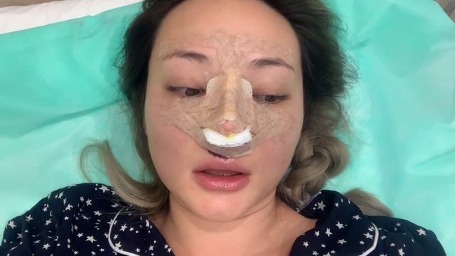 Моя ринопластика от А до Я | Открытая ринопластика азиатского носа | Отзыв смотреть онлайн