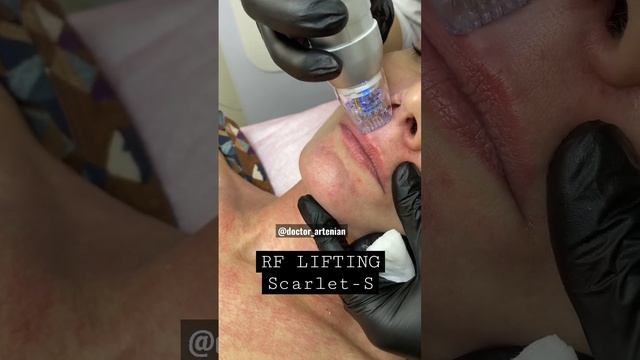 Rf lifting #scarlet #antiaging #acne #youtube #botox #laser #clinic #НазелиАртенян #NazeliArtenian смотреть онлайн